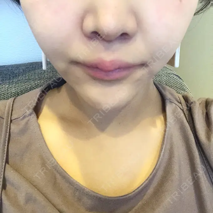 人中短縮 新宿ラクル美容外科クリニック 新宿院 DAY 18 メイン用