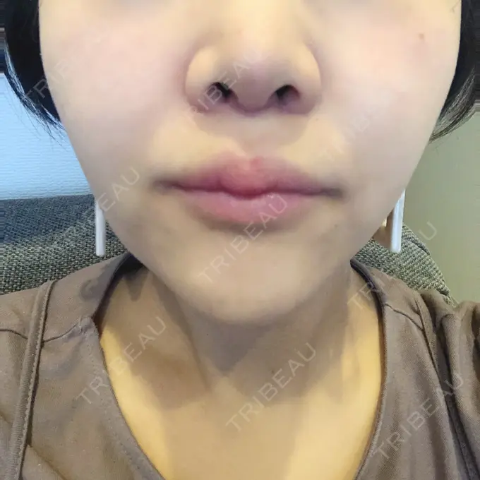 人中短縮 新宿ラクル美容外科クリニック 新宿院 DAY 18 メイン用