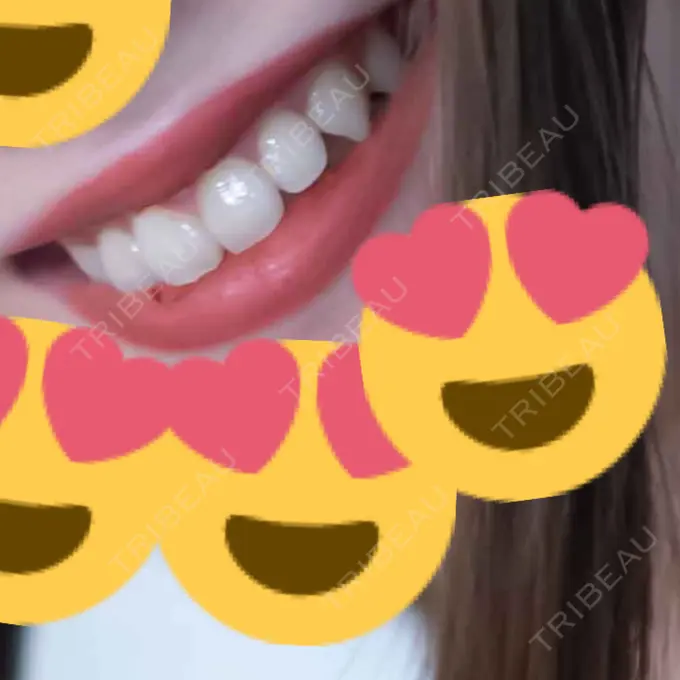 ホワイトニング ティースアート　新宿店 AFTER メイン用