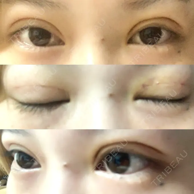 二重埋没 城本クリニック 福岡院 DAY 3 メイン用