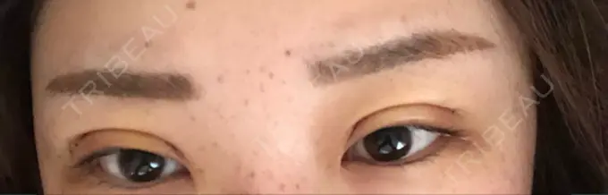 二重切開 品川スキンクリニック広島院 DAY 4 メイン用