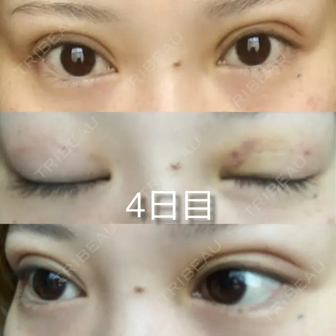 二重埋没 城本クリニック 福岡院 DAY 4 メイン用