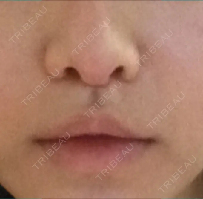 小鼻縮小（切開） / 人中短縮 南クリニック DAY 21 メイン用