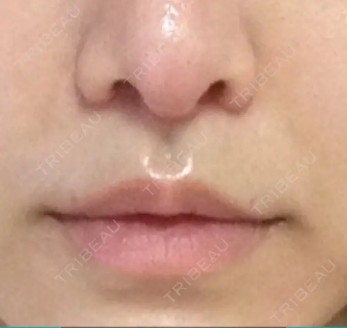 小鼻縮小（切開） / 人中短縮 南クリニック DAY 65 メイン用