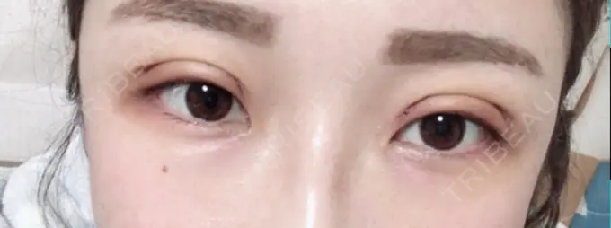 二重切開 品川スキンクリニック広島院 DAY 5 メイン用