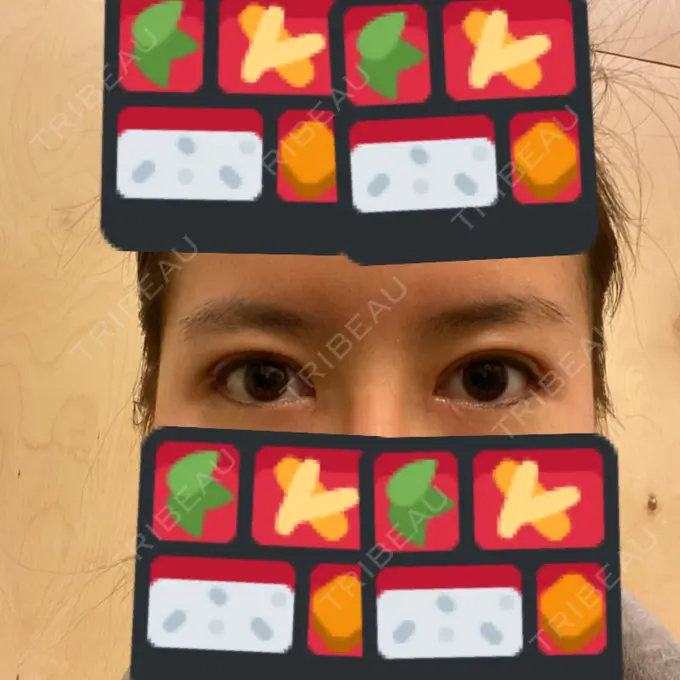 二重切開 / 目頭切開 / 眼瞼下垂（切開） / 目尻切開 RG整形外科（旧リオン整形外科） DAY 33 メイン用