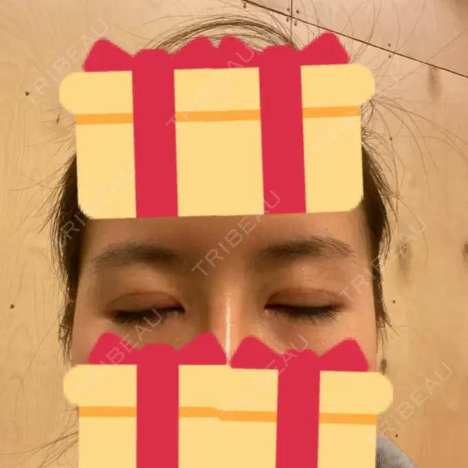 二重切開 / 目頭切開 / 眼瞼下垂（切開） / 目尻切開 RG整形外科（旧リオン整形外科） DAY 33 メイン用