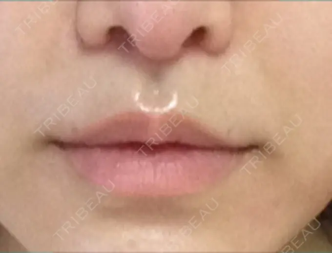 小鼻縮小（切開） / 人中短縮 南クリニック DAY 65 メイン用