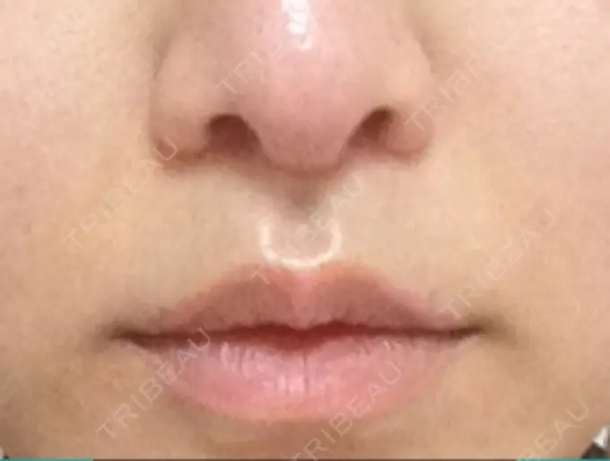 小鼻縮小（切開） / 人中短縮 南クリニック DAY 85 メイン用