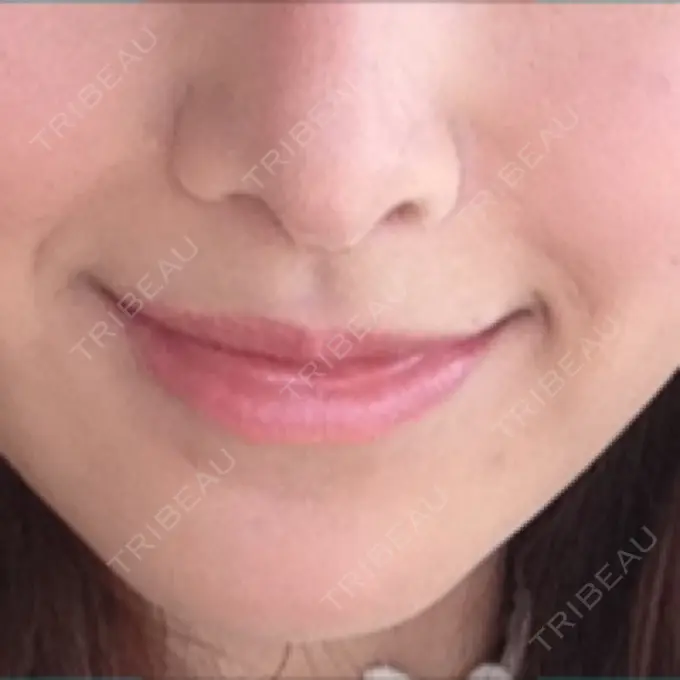 小鼻縮小（切開） / 人中短縮 南クリニック AFTER メイン用