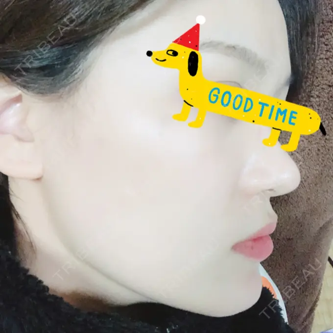 隆鼻術 / 鼻尖形成（切開） / 鼻中隔延長（切開） / 軟骨移植 / 鼻修正 / 鼻孔縁下降 エートップ美容整形外科 DAY 232 メイン用