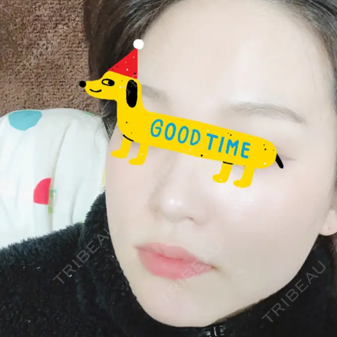 隆鼻術 / 鼻尖形成（切開） / 鼻中隔延長（切開） / 軟骨移植 / 鼻修正 / 鼻孔縁下降 エートップ美容整形外科 DAY 232 メイン用