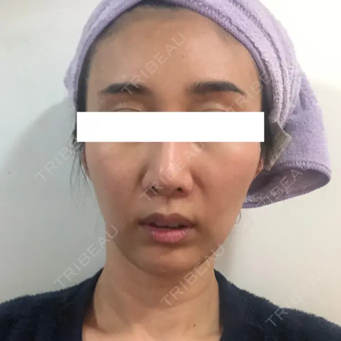 糸リフト / 額を丸く / 人中短縮 / こめかみ形成 / ヒアルロン酸注入（あご） / ボトックス（エラ・小顔） / ヒアルロン酸注入（頬） あきこクリニック DAY 48 メイン用