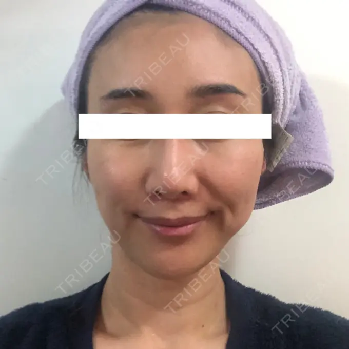 糸リフト / 額を丸く / 人中短縮 / こめかみ形成 / ヒアルロン酸注入（あご） / ボトックス（エラ・小顔） / ヒアルロン酸注入（頬） あきこクリニック DAY 48 メイン用