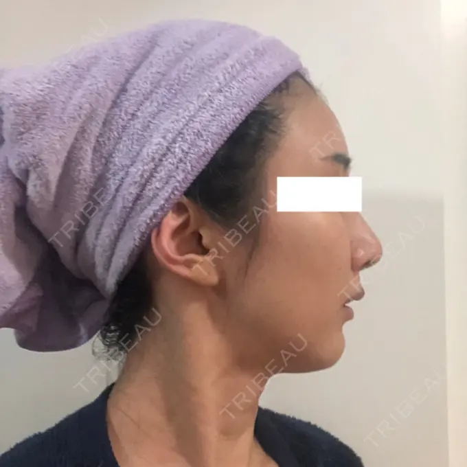 糸リフト / 額を丸く / 人中短縮 / こめかみ形成 / ヒアルロン酸注入（あご） / ボトックス（エラ・小顔） / ヒアルロン酸注入（頬） あきこクリニック DAY 48 メイン用