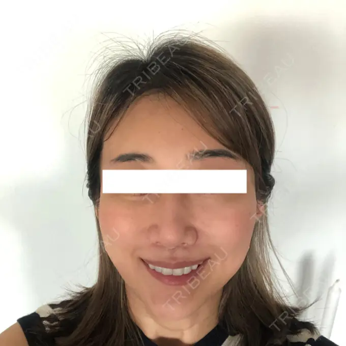 糸リフト / 額を丸く / 人中短縮 / こめかみ形成 / ヒアルロン酸注入（あご） / ボトックス（エラ・小顔） / ヒアルロン酸注入（頬） あきこクリニック AFTER メイン用