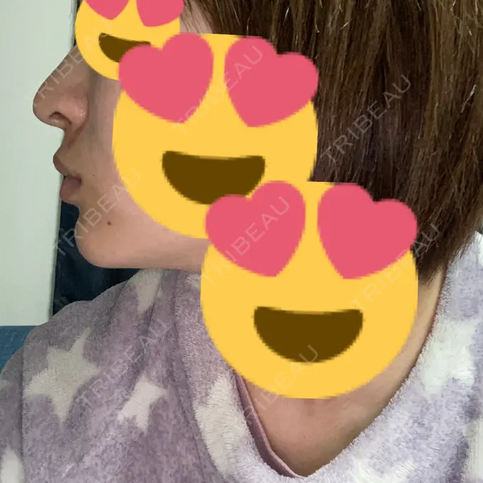 鼻中隔延長（切開） / ヒアルロン酸注入（あご） あいちビューティークリニック栄本院 DAY 4 メイン用