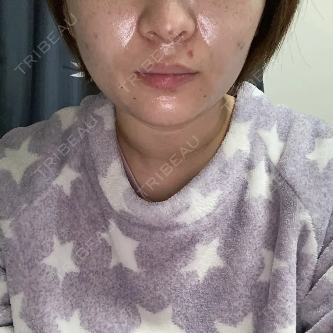 鼻中隔延長（切開） / ヒアルロン酸注入（あご） あいちビューティークリニック栄本院 DAY 4 メイン用