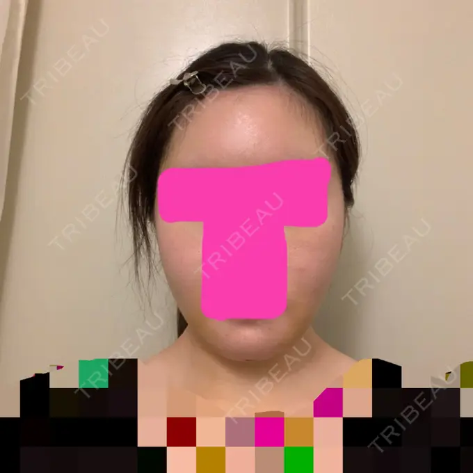 糸リフト / 骨切り（あご） / 骨削り（エラ） / 骨削り（頬） / 脂肪吸引（顔） / 脂肪注入（輪郭） RG整形外科（旧リオン整形外科） AFTER メイン用