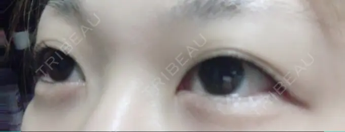 二重埋没 いわきタウン形成外科クリニック DAY 209 メイン用