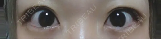 二重埋没 いわきタウン形成外科クリニック AFTER メイン用