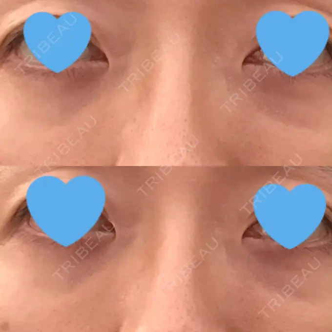 クマ治療 / 下まぶたたるみ取り / 下まぶたの脂肪取り 湘南美容クリニック 大阪あべの院 DAY 63 メイン用