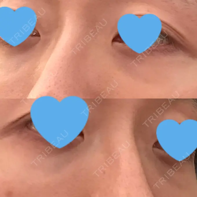 クマ治療 / 下まぶたたるみ取り / 下まぶたの脂肪取り 湘南美容クリニック 大阪あべの院 DAY 63 メイン用