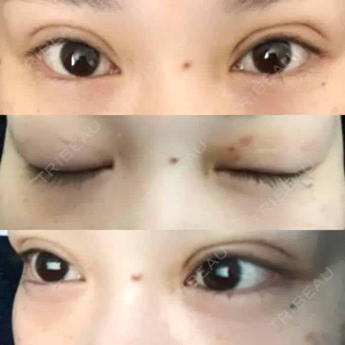 二重埋没 城本クリニック 福岡院 DAY 7 メイン用