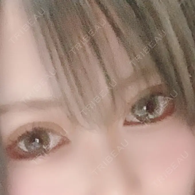 二重埋没 城本クリニック 福岡院 DAY 7 メイン用