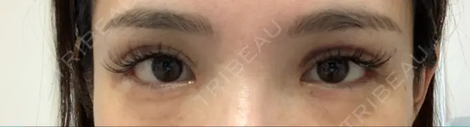 二重埋没 / 目頭切開 / 目尻切開 / タレ目形成・グラマラスライン（切開） RG整形外科（旧リオン整形外科） AFTER メイン用