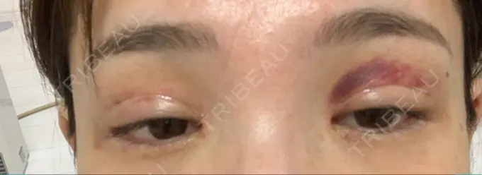 二重埋没 / 目頭切開 / 目尻切開 / タレ目形成・グラマラスライン（切開） RG整形外科（旧リオン整形外科） DAY 18 メイン用