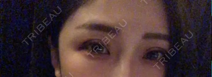 二重切開 品川スキンクリニック広島院 DAY 8 メイン用