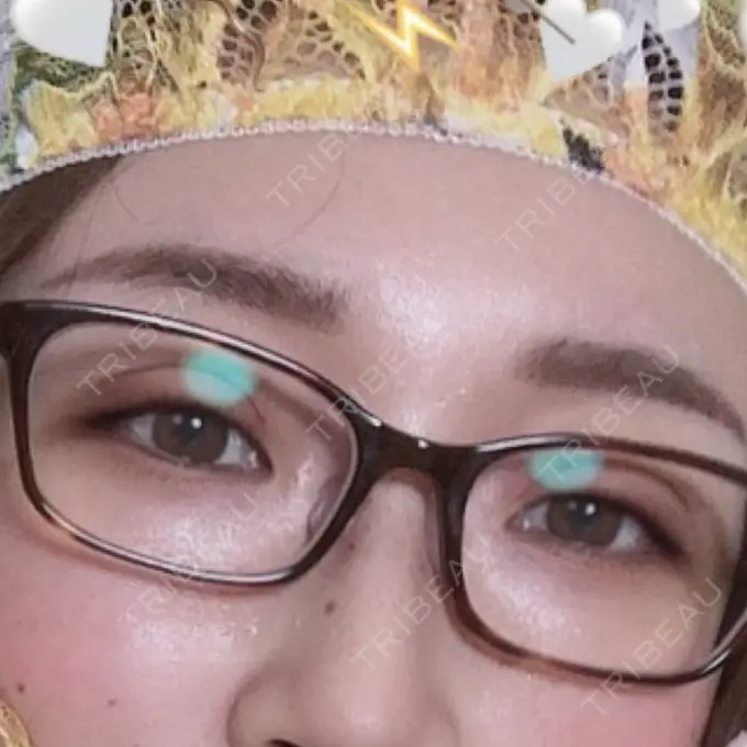 二重切開 品川スキンクリニック広島院 DAY 6 メイン用