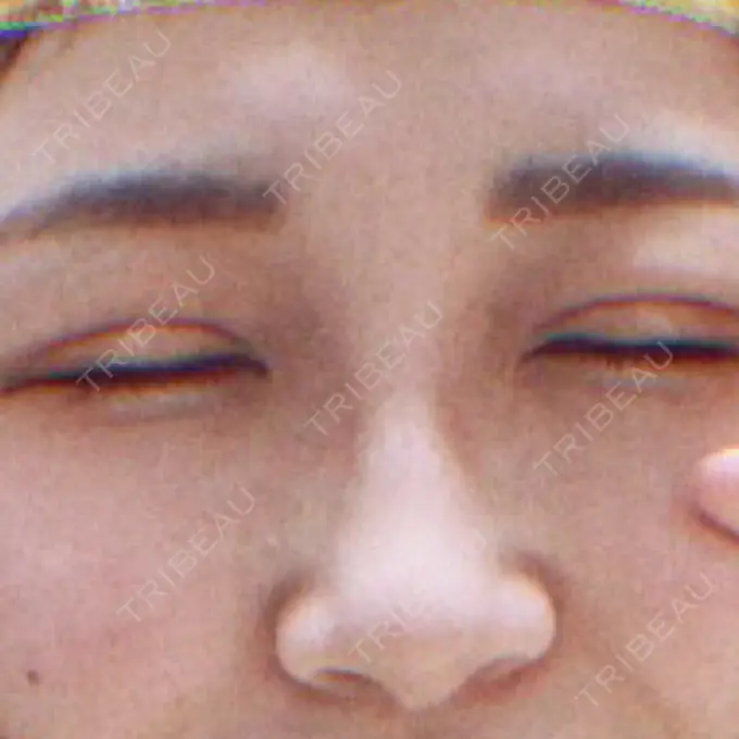 二重切開 品川スキンクリニック広島院 DAY 6 メイン用