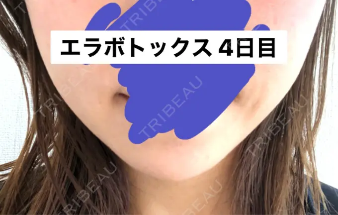 ボトックス（エラ・小顔） 湘南美容クリニック 新橋銀座口院 DAY 4 メイン用