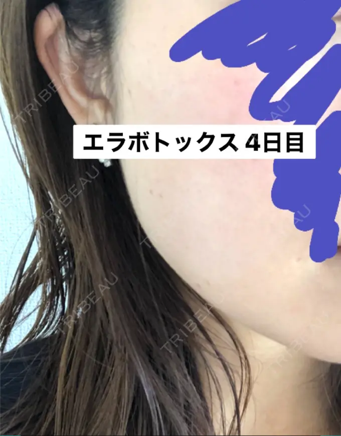 ボトックス（エラ・小顔） 湘南美容クリニック 新橋銀座口院 DAY 4 メイン用