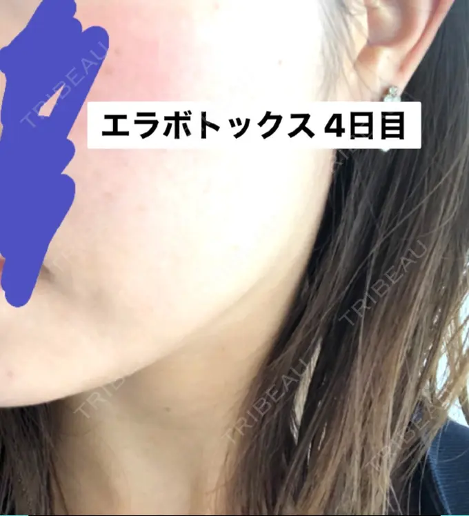 ボトックス（エラ・小顔） 湘南美容クリニック 新橋銀座口院 DAY 4 メイン用