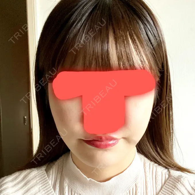 脂肪吸引（顔） / ボトックス（エラ・小顔） / 美容点滴・美容注射（美肌） エートップ美容整形外科 AFTER メイン用