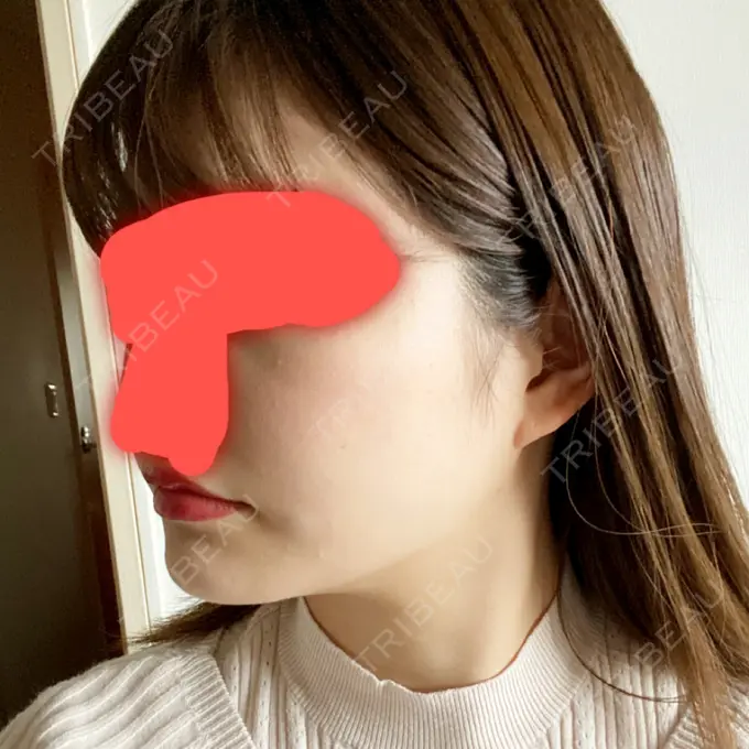 脂肪吸引（顔） / ボトックス（エラ・小顔） / 美容点滴・美容注射（美肌） エートップ美容整形外科 DAY 61 メイン用