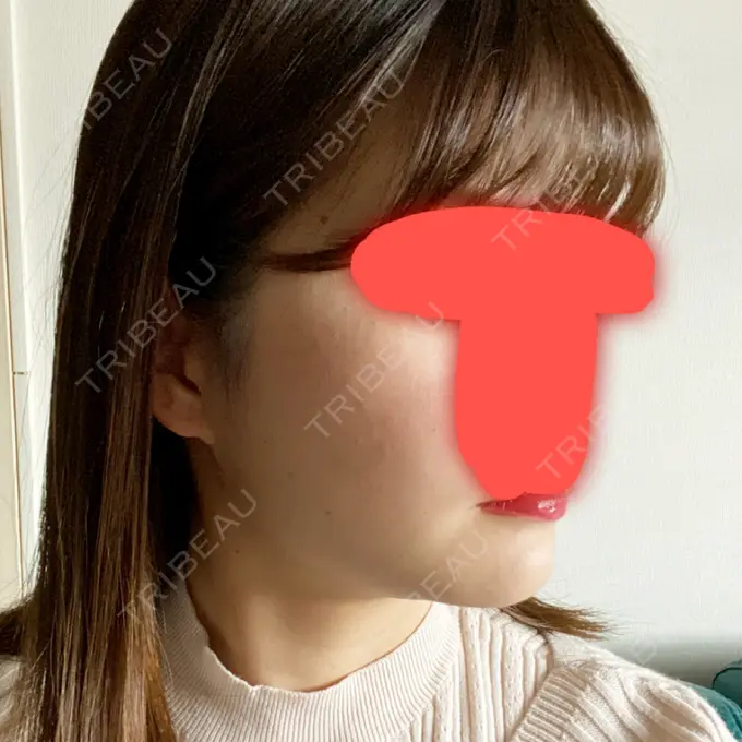 脂肪吸引（顔） / ボトックス（エラ・小顔） / 美容点滴・美容注射（美肌） エートップ美容整形外科 DAY 61 メイン用