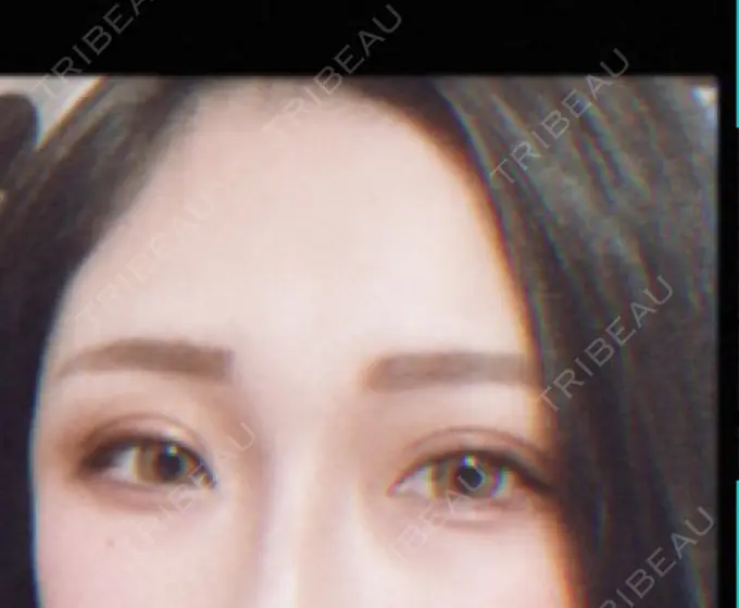 二重切開 品川スキンクリニック広島院 DAY 9 メイン用