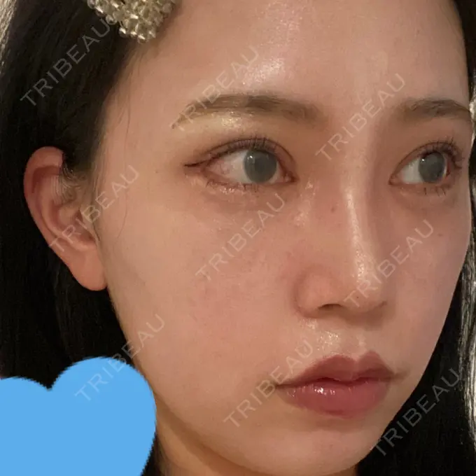 目頭切開 / 鼻尖形成（切開） / 額を丸く / 目尻切開 / 上まぶたの脂肪取り / 軟骨移植 / 脂肪注入（輪郭） TN整形外科 AFTER メイン用