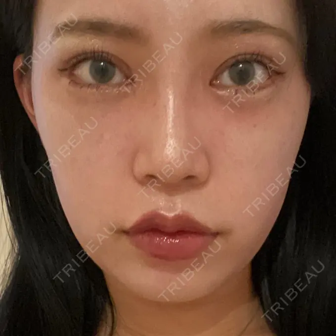 目頭切開 / 鼻尖形成（切開） / 額を丸く / 目尻切開 / 上まぶたの脂肪取り / 軟骨移植 / 脂肪注入（輪郭） TN整形外科 DAY 18 メイン用