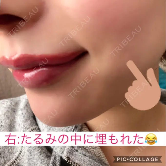 その他（輪郭） / その他（口元） / その他 ドクターゴールドマンクリニック 東京高輪院 AFTER メイン用