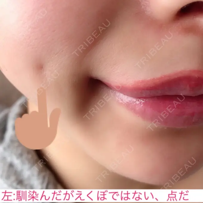 その他（輪郭） / その他（口元） / その他 ドクターゴールドマンクリニック 東京高輪院 DAY 288 メイン用