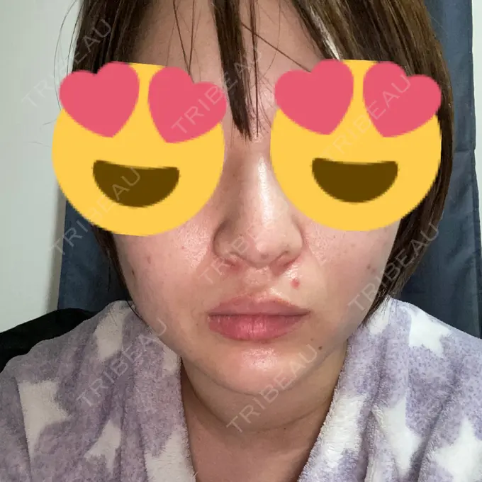 鼻中隔延長（切開） / ヒアルロン酸注入（あご） あいちビューティークリニック栄本院 DAY 7 メイン用