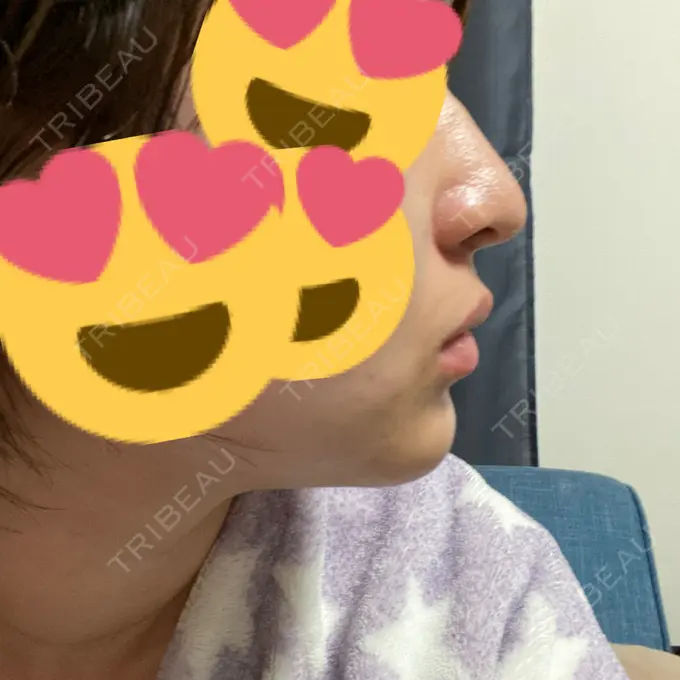 鼻中隔延長（切開） / ヒアルロン酸注入（あご） あいちビューティークリニック栄本院 DAY 7 メイン用