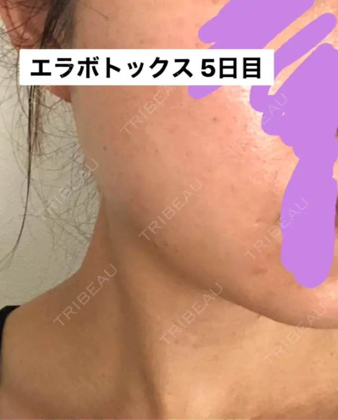 ボトックス（エラ・小顔） 湘南美容クリニック 新橋銀座口院 DAY 5 メイン用