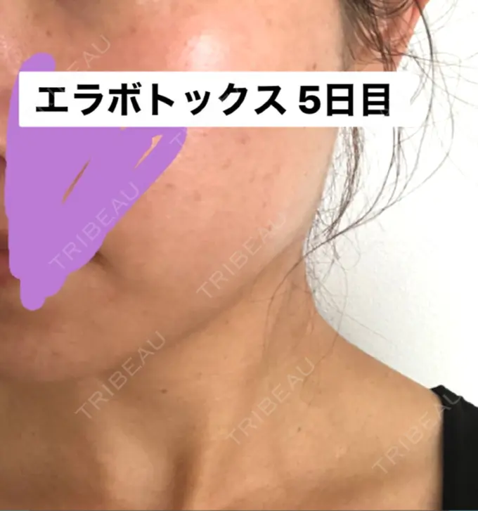 ボトックス（エラ・小顔） 湘南美容クリニック 新橋銀座口院 DAY 5 メイン用