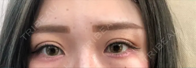 二重切開 品川スキンクリニック広島院 DAY 10 メイン用